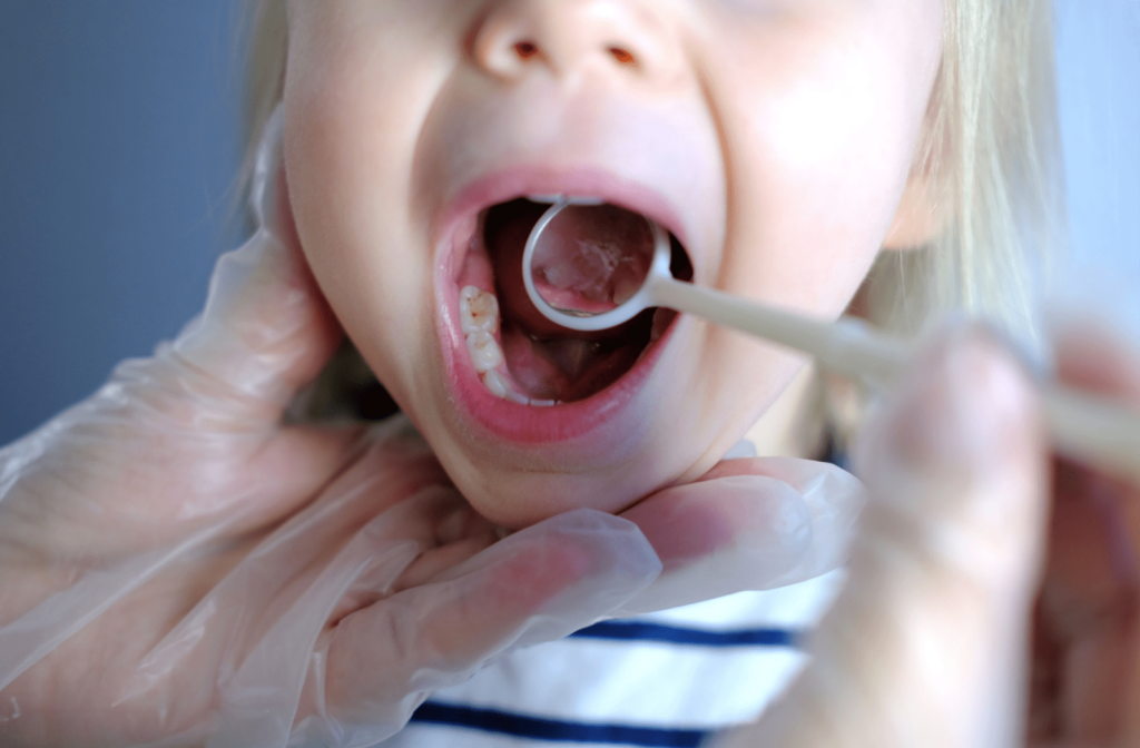 Close-up of toddler's mouth and a hand of a dentist holding a dental mirror examining her teeth with cavities