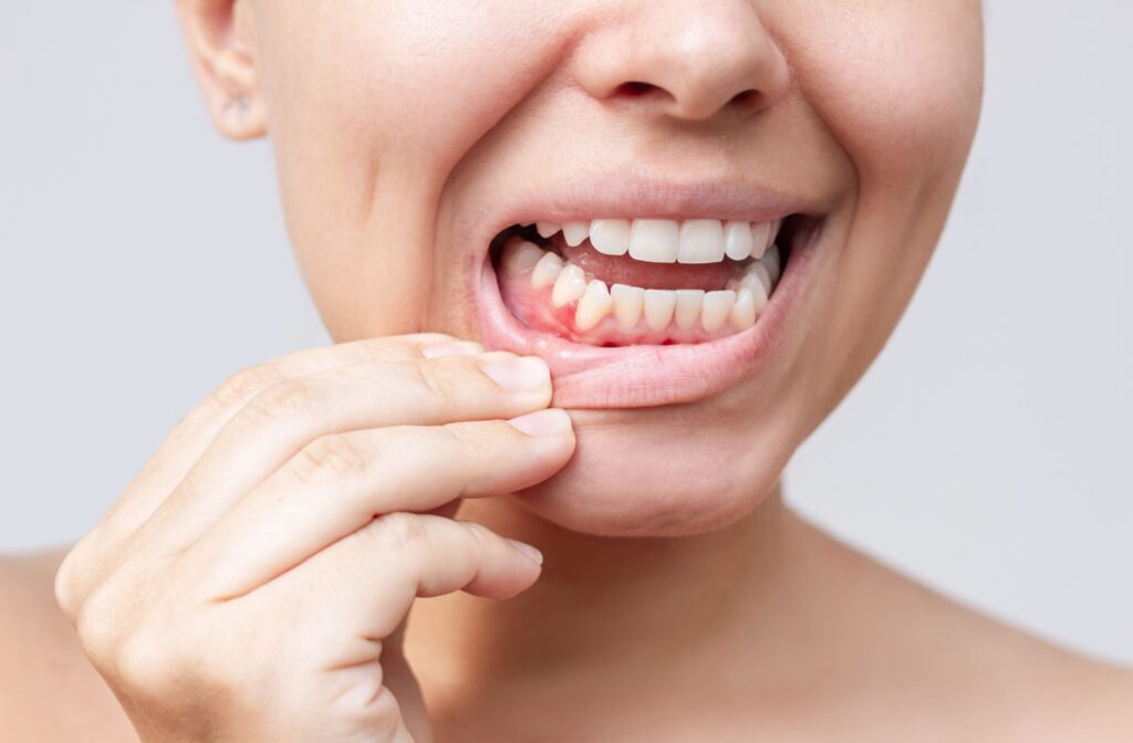 A close up of the gums of someone suffering from gum disease.